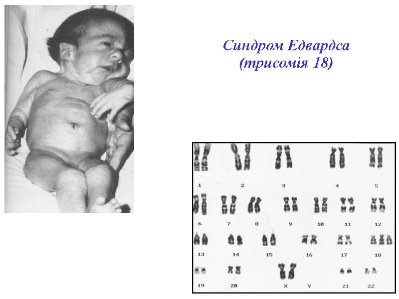 Синдром Едвардса (трисомія 18)‏